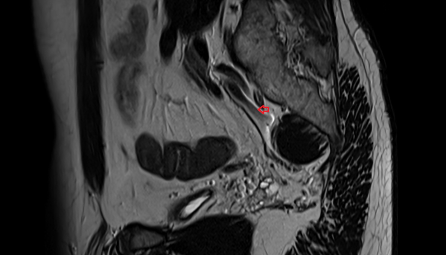 internal iliac vein MRI  sag  anatomy  image-img-00000-00000