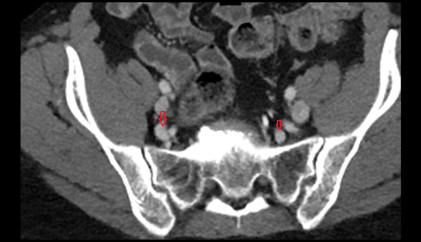 internal iliac vein ct axial image