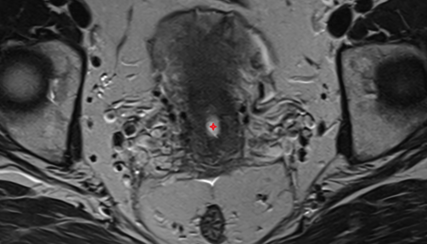internal os of the cervix  MRI  AXIAL  anatomy  image-img-00000-00000