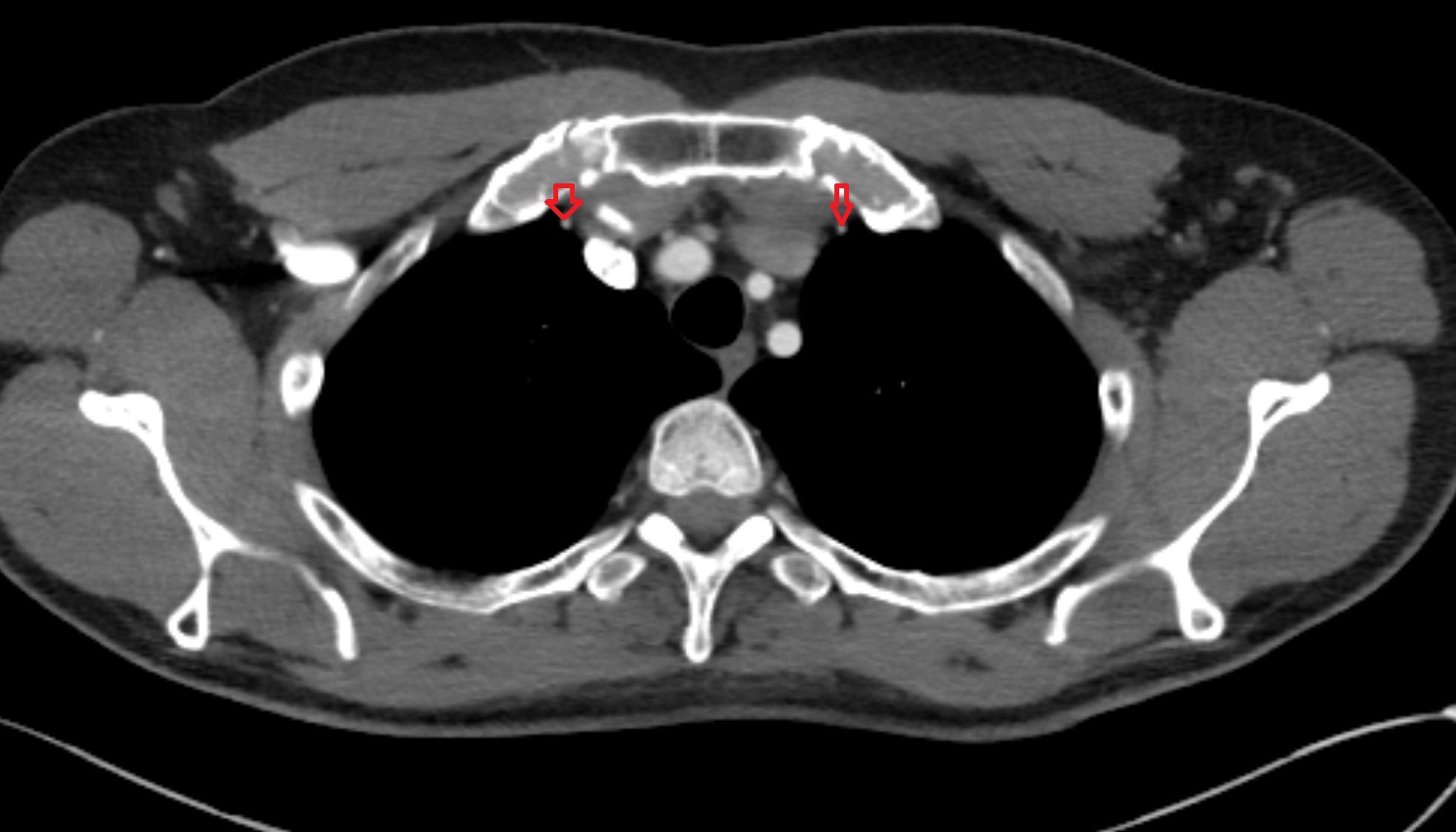 internal thoracic artery CT axial  image -img-00000-00000_00001
