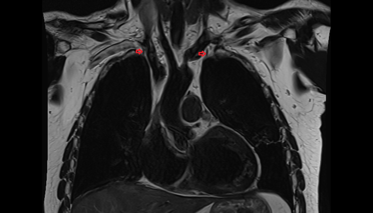 i nternal thoracic artery anatomy MRI coronal  image -img-00000-00000