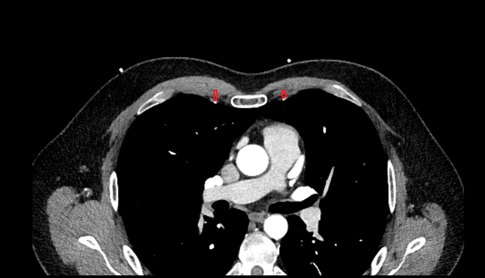 internal thoracic artery ct axial