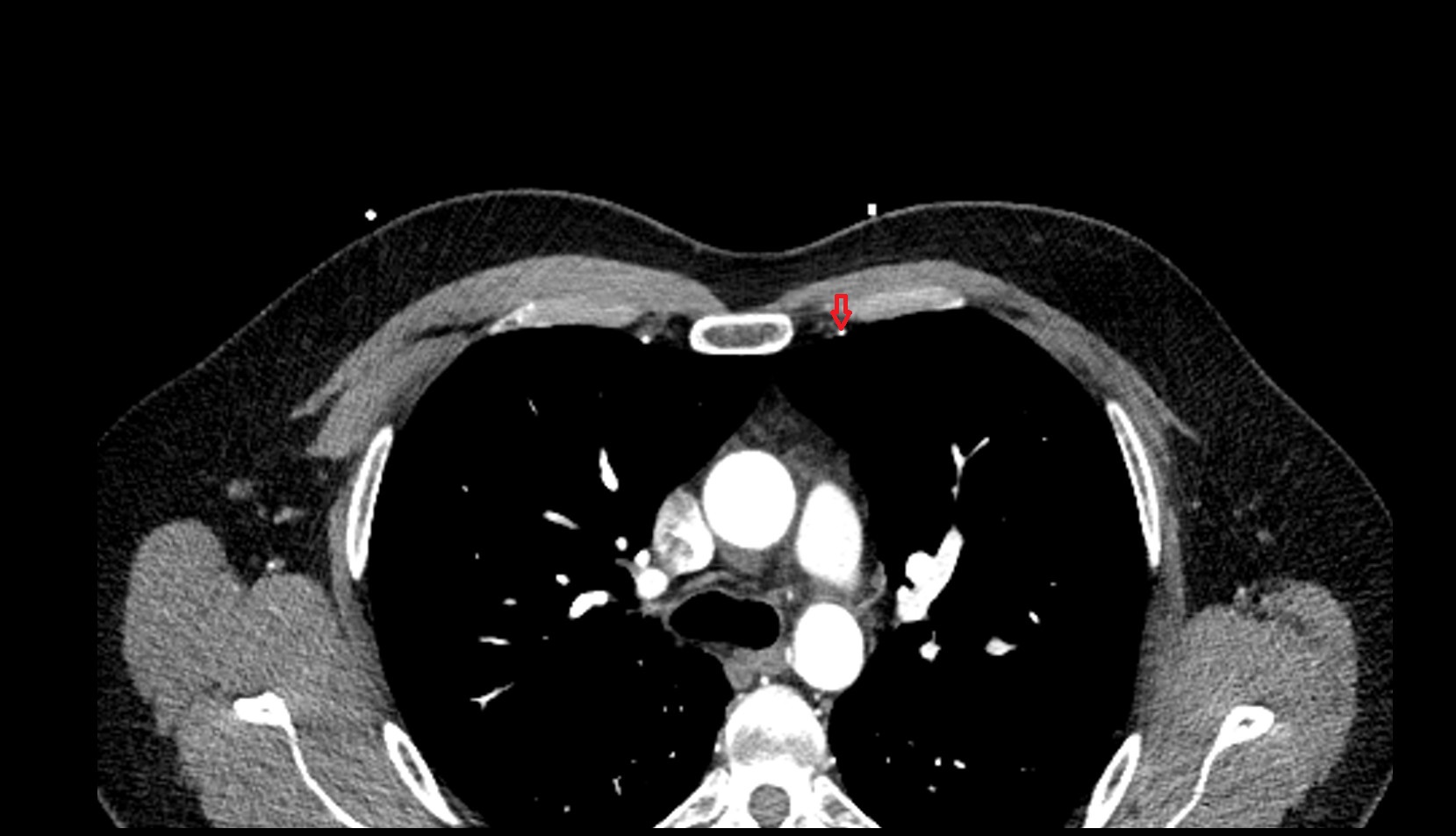 internal thoracic artery left