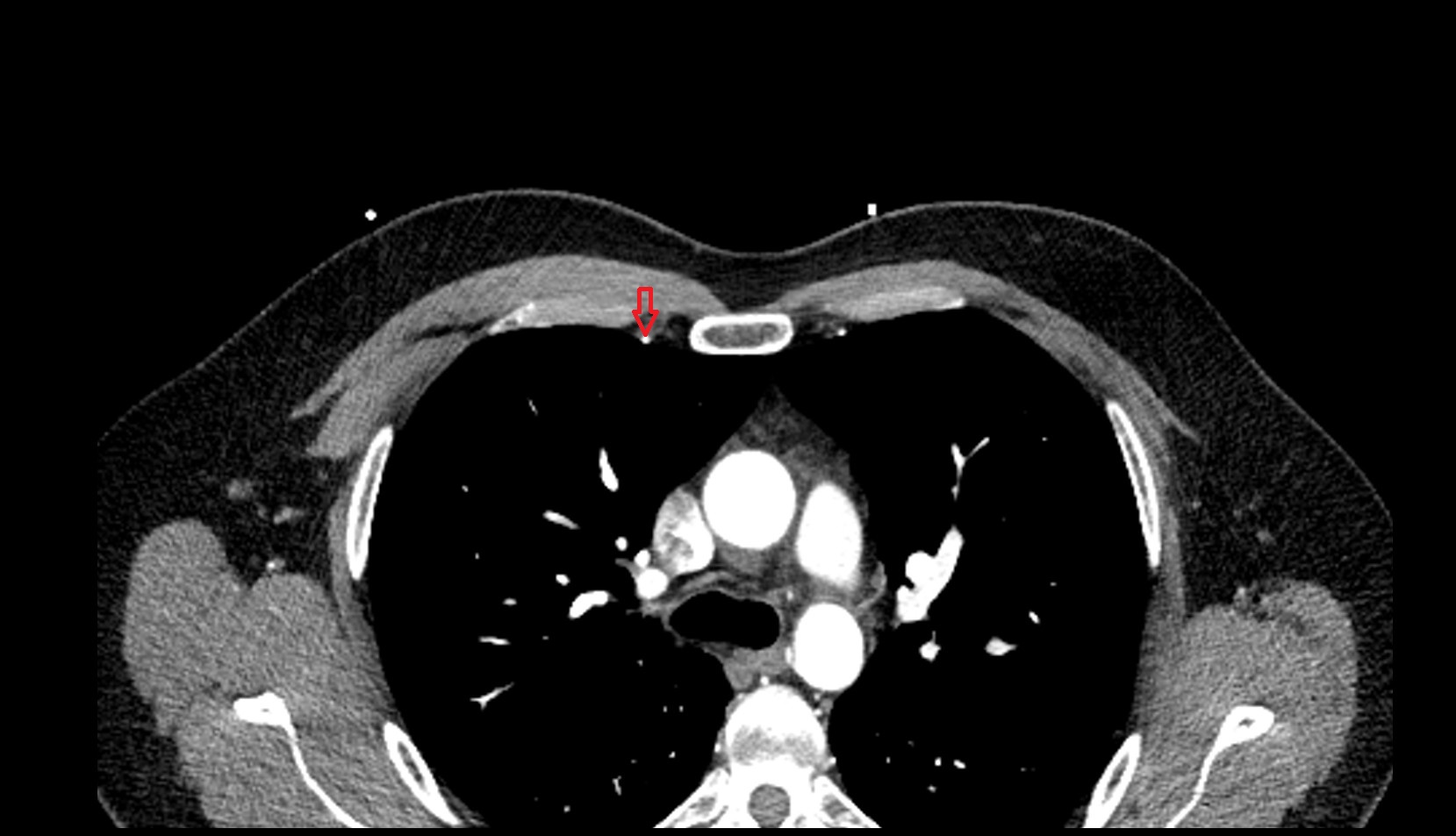 internal thoracic artery right