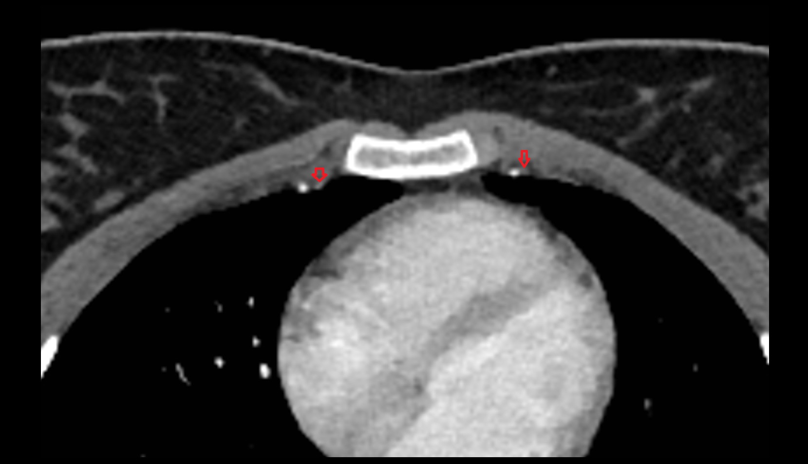 internal thoracic veins  ct   anatomy  image -img-00000-00000