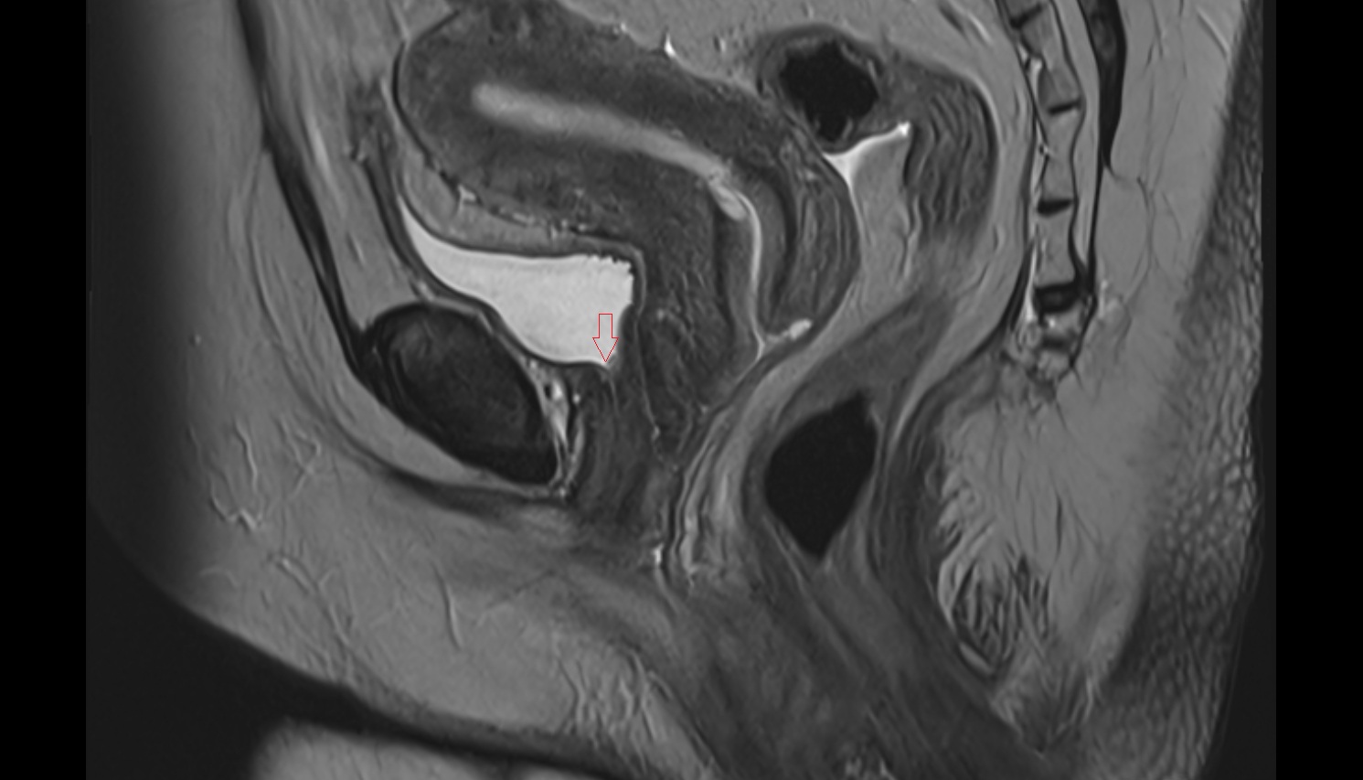 internal urethral orifice  MRI  sagittal anatomy  FEMALE