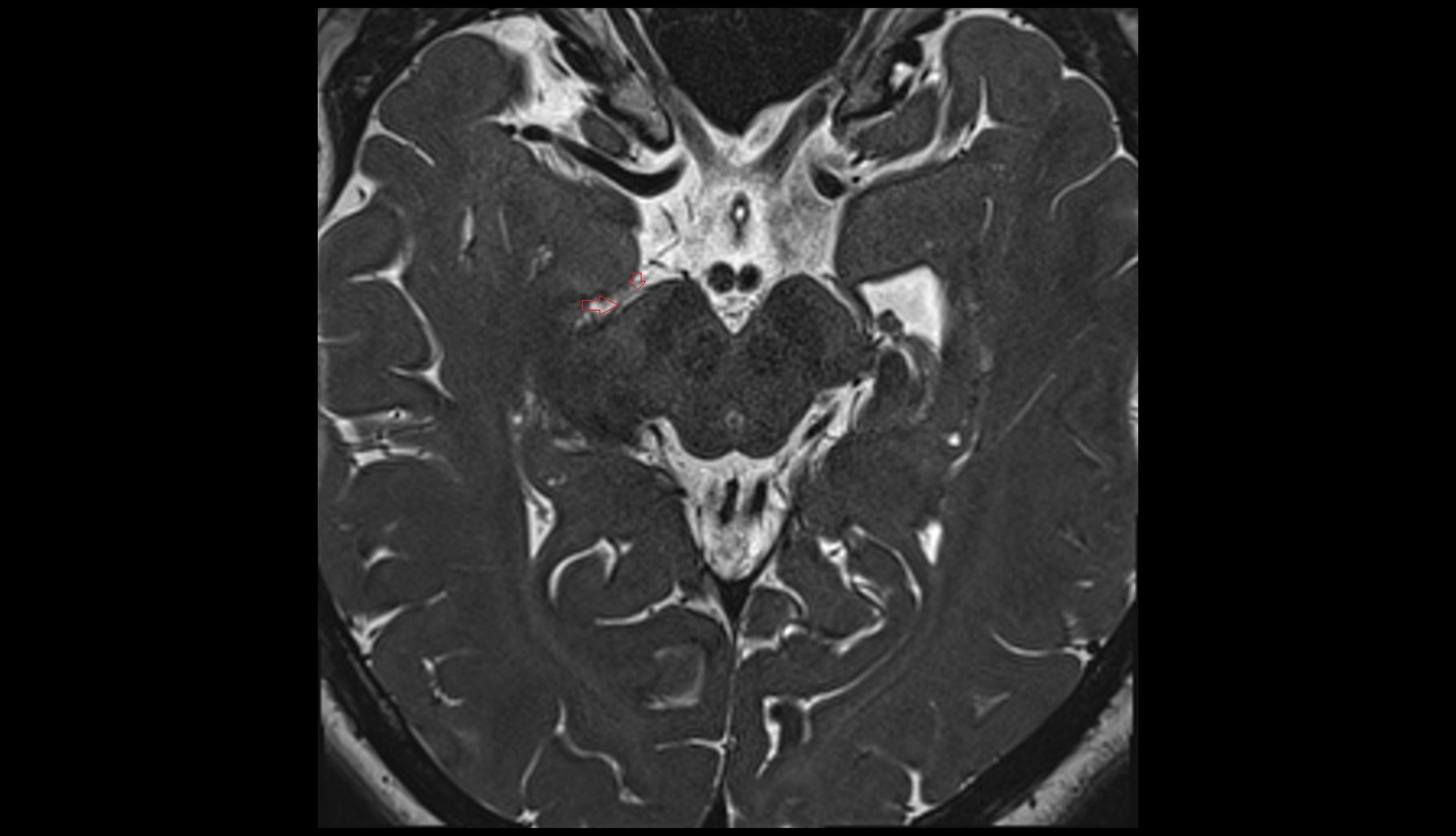 interpeduncular veins MRI 3T axial image