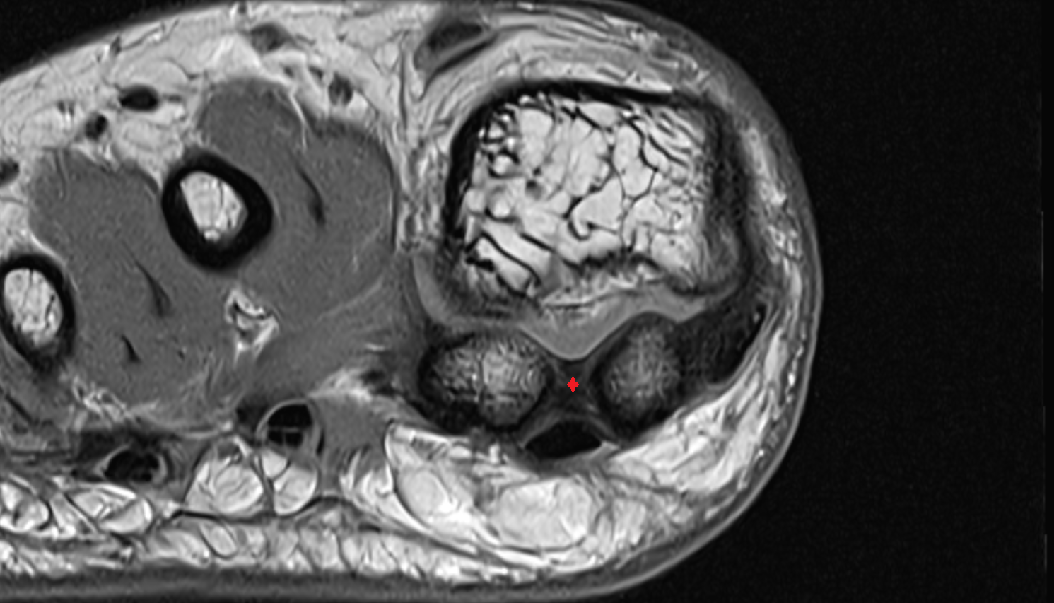 intersesamoid ligament of foot  axial cross sectional anatomy 3T MRI AI enhanced radiology image-img-00000-00000
