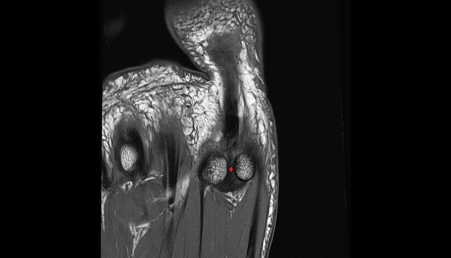 intersesamoid ligament of foot  coronal cross sectional anatomy 3T MRI AI enhanced radiology image-img-00000-00000_00001