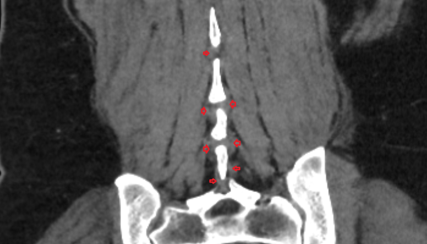 interspinales muscles  CT coronal  image anatomy  image -img-00000-00000_00001