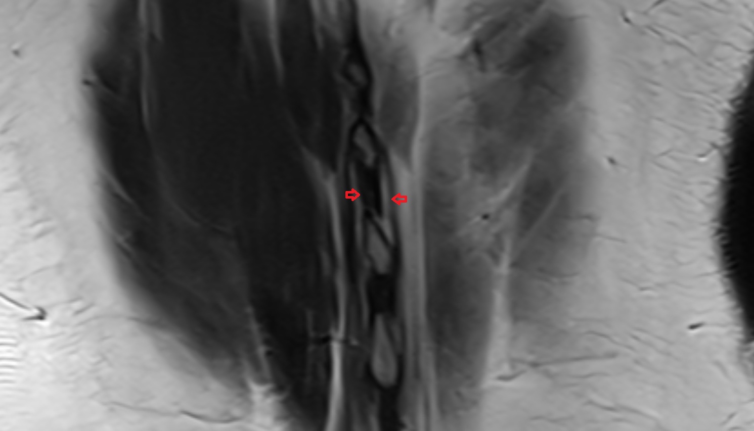 interspinales muscles   MRI  coronal  image anatomy  image -img-00000-00000