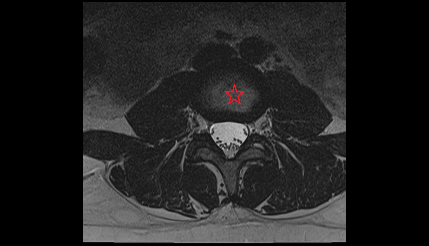 intervertebral disc axial image