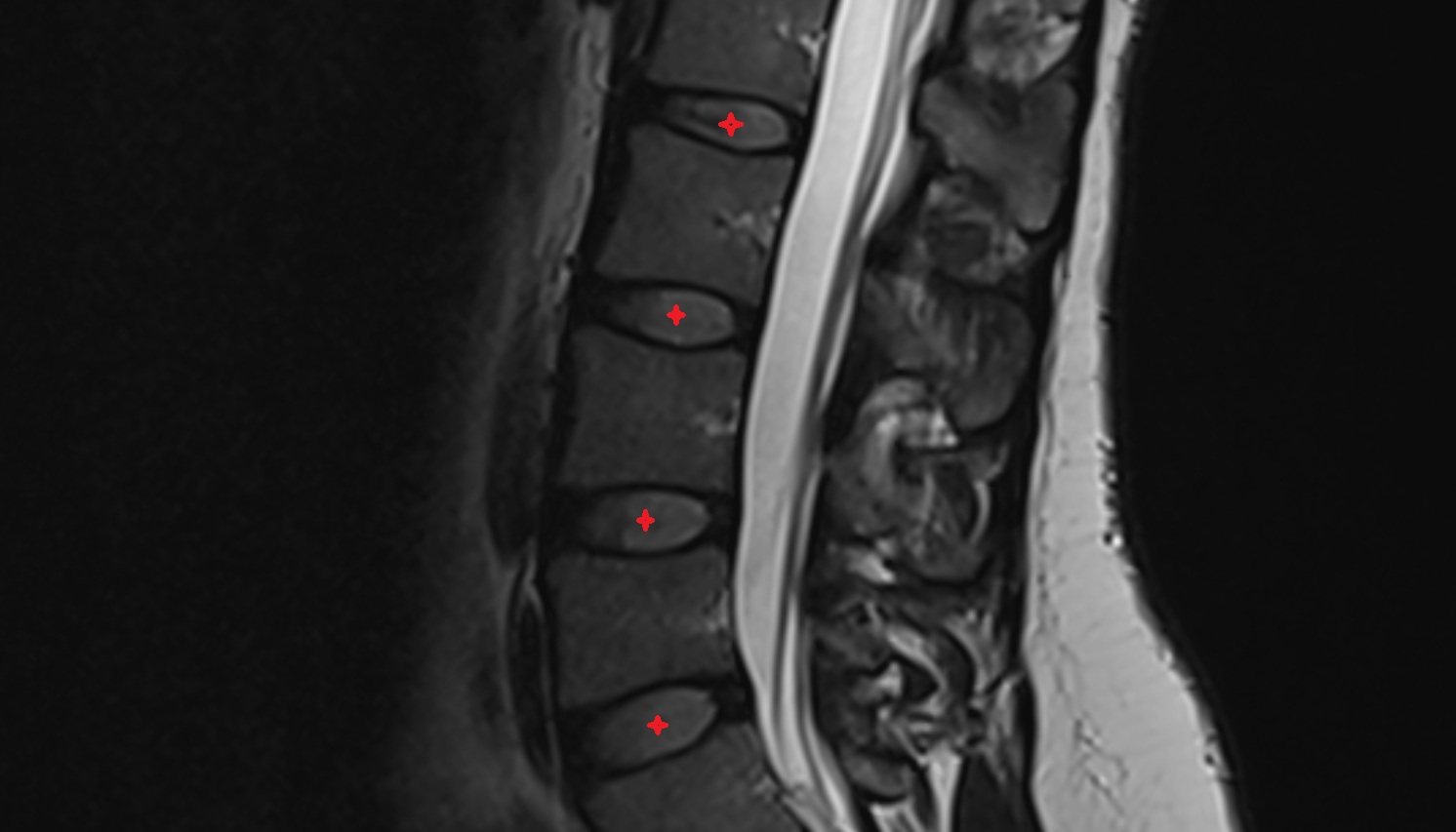 intervertebral disc  mri sag  image -img-00000-00000