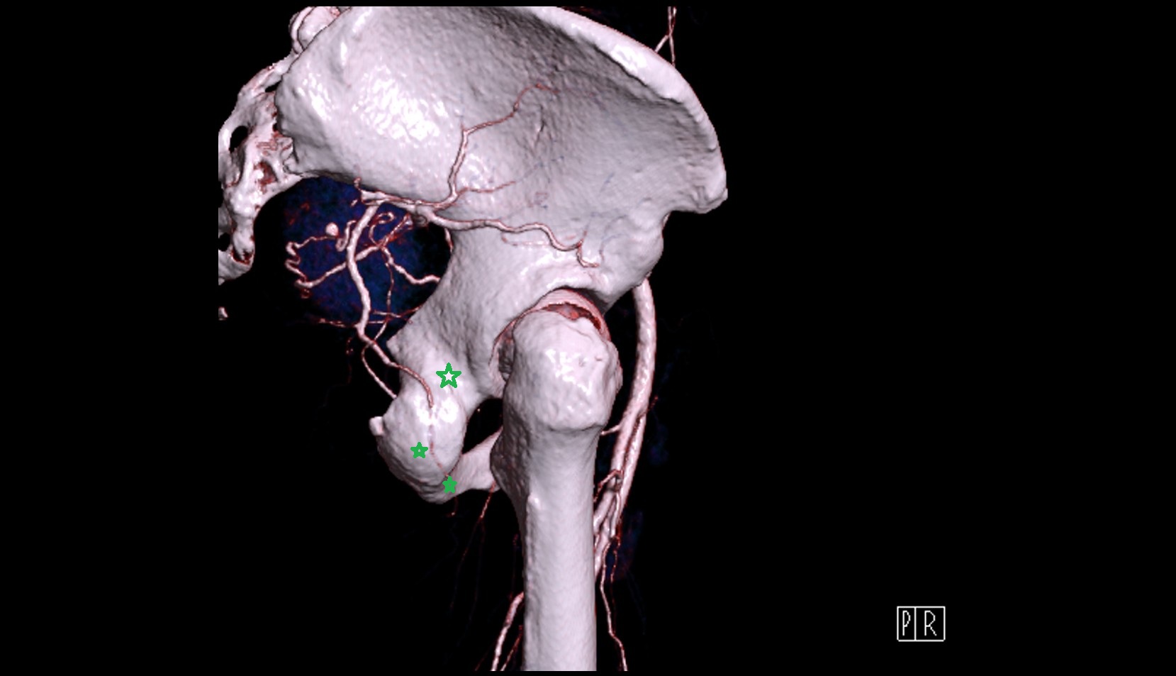 ischium bone 3d image