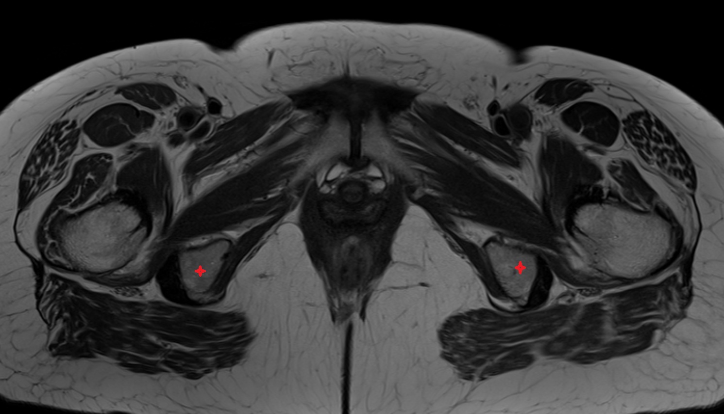 ischium bone  MRI  axial  anatomy  image-img-00000-00000