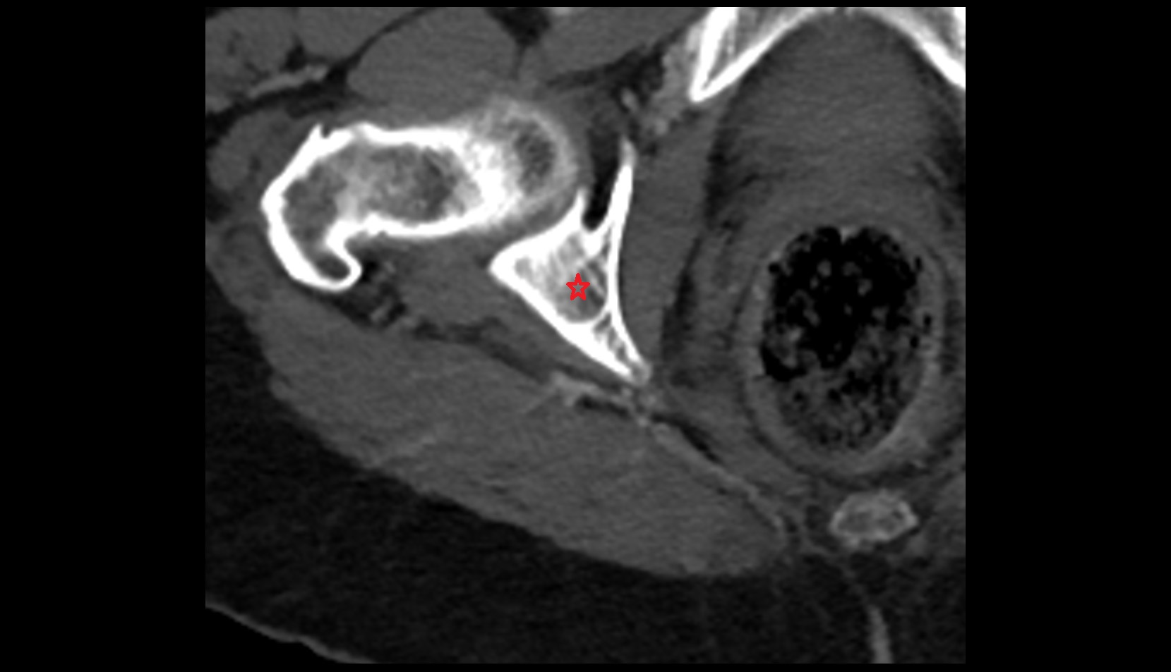 ischium bone ct axial image