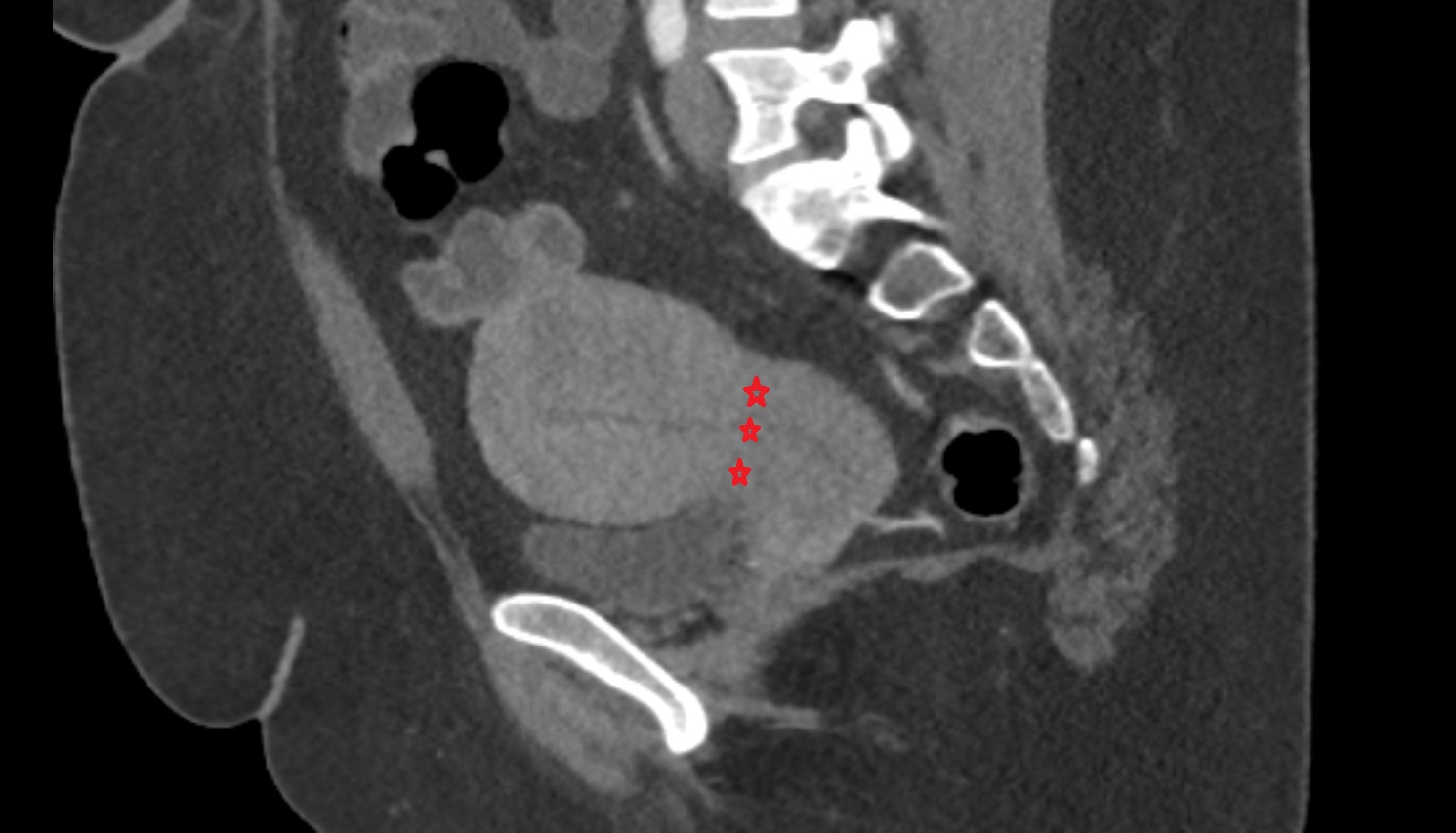 isthmus of uterus CT sagittal  image anatomy  image-img-00000-00000