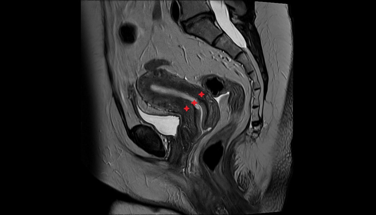 isthmus of uterus MRI  sagittal  image anatomy  image-img-00000-00000
