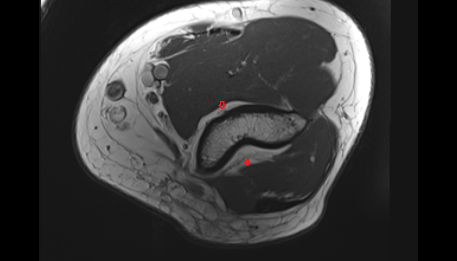 joint capsule of elbow axial cross sectional anatomy 3T MRI AI enhanced radiology image -img-00000-00000