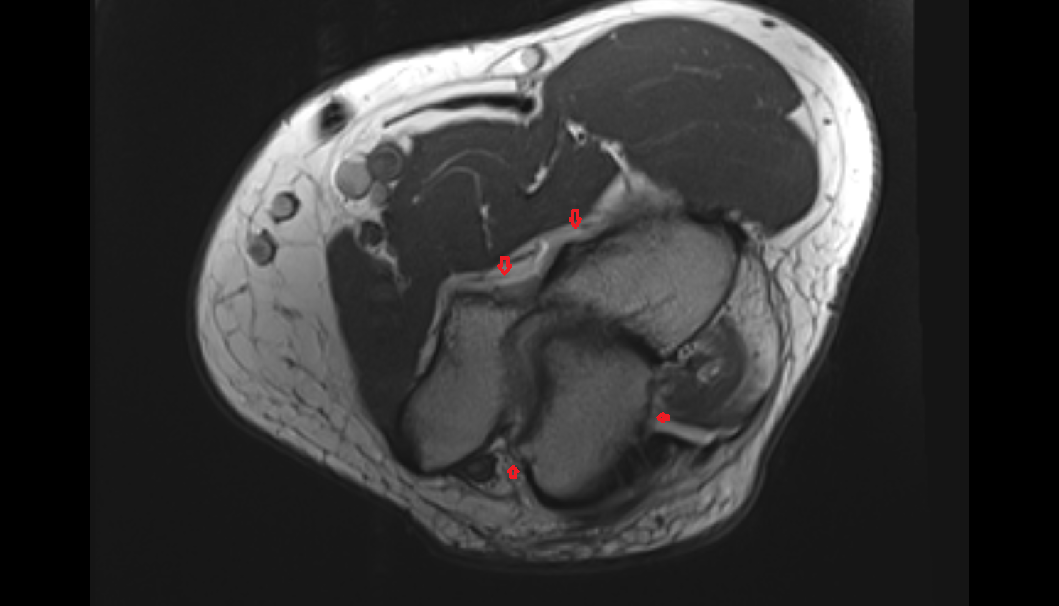 joint capsule of elbow axial cross sectional anatomy 3T MRI AI enhanced radiology image -img-00000-00000_00001