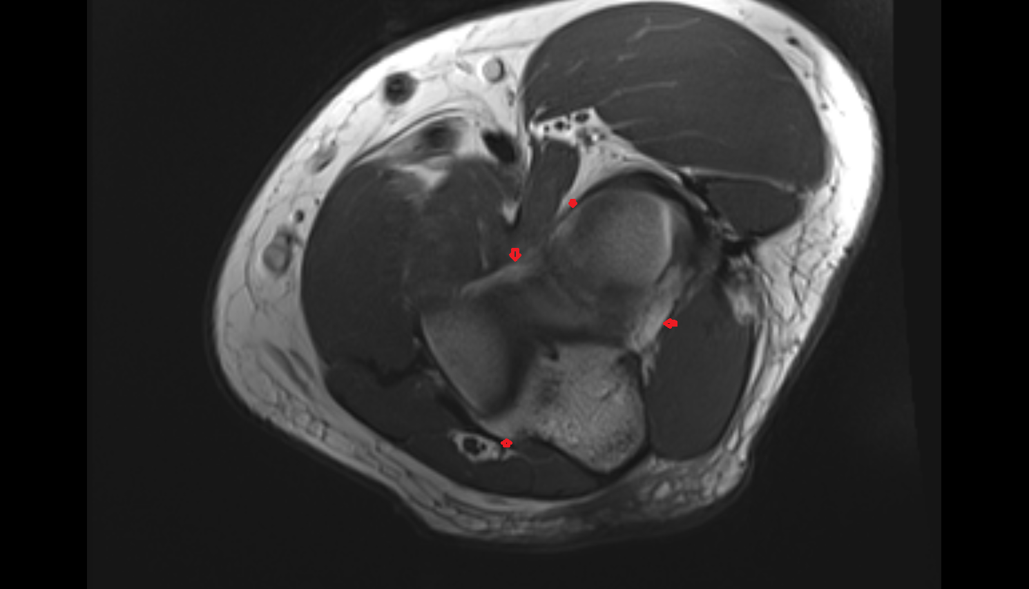 joint capsule of elbow axial cross sectional anatomy 3T MRI AI enhanced radiology image -img-00000-00000_00002