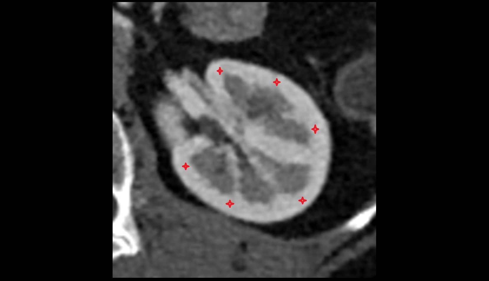 kidney cortex (renal cortex)  CT axial image