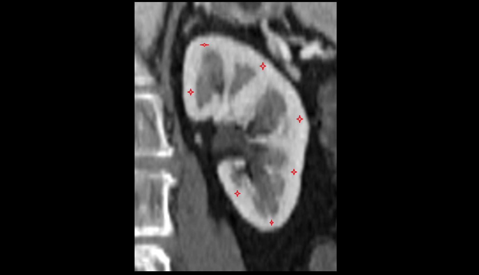 kidney cortex (renal cortex)  CT coronal image
