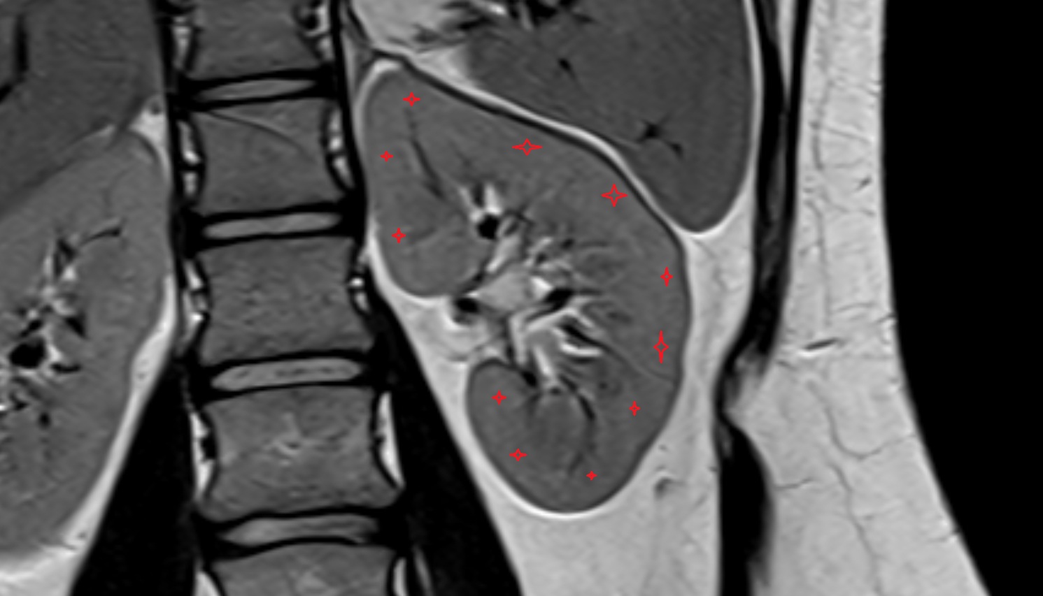 kidney cortex (renal cortex)  MRI coronal  image anatomy  image -img-00000-00000
