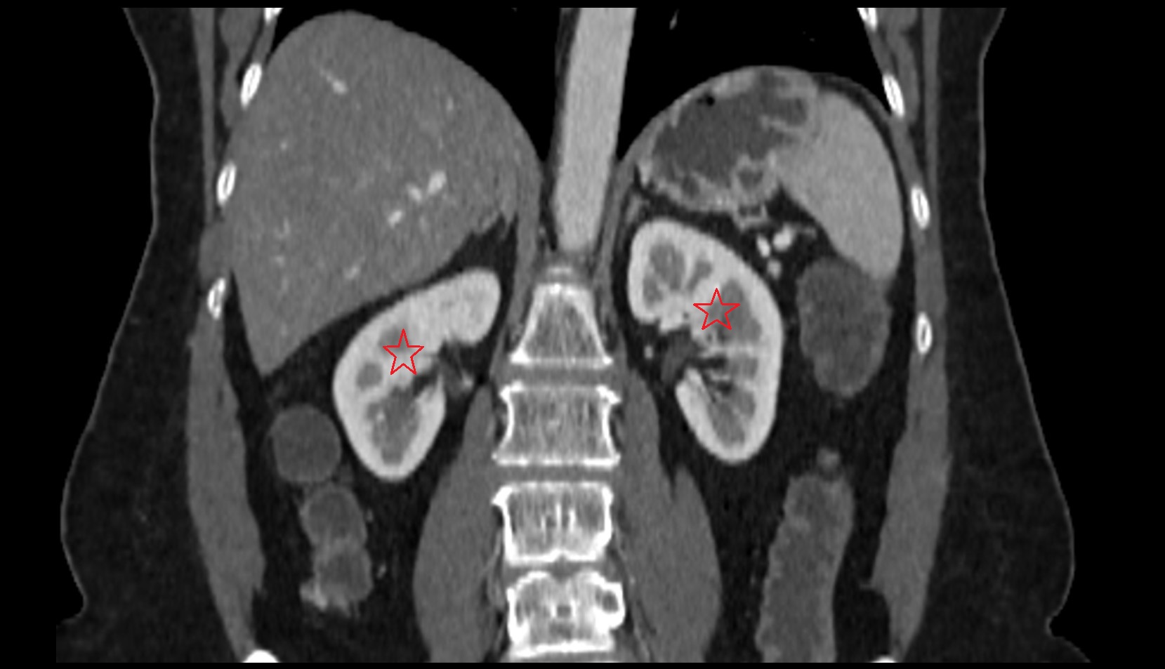 kidneys  CT coronal image
