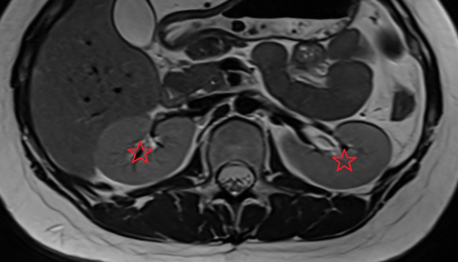 kidneys  MRI  axial  image anatomy  image -img-00000-00000