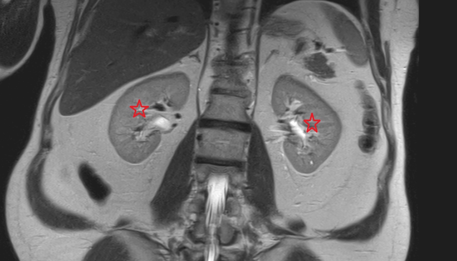 kidneys  MRI  coronal  image anatomy  image -img-00000-00000