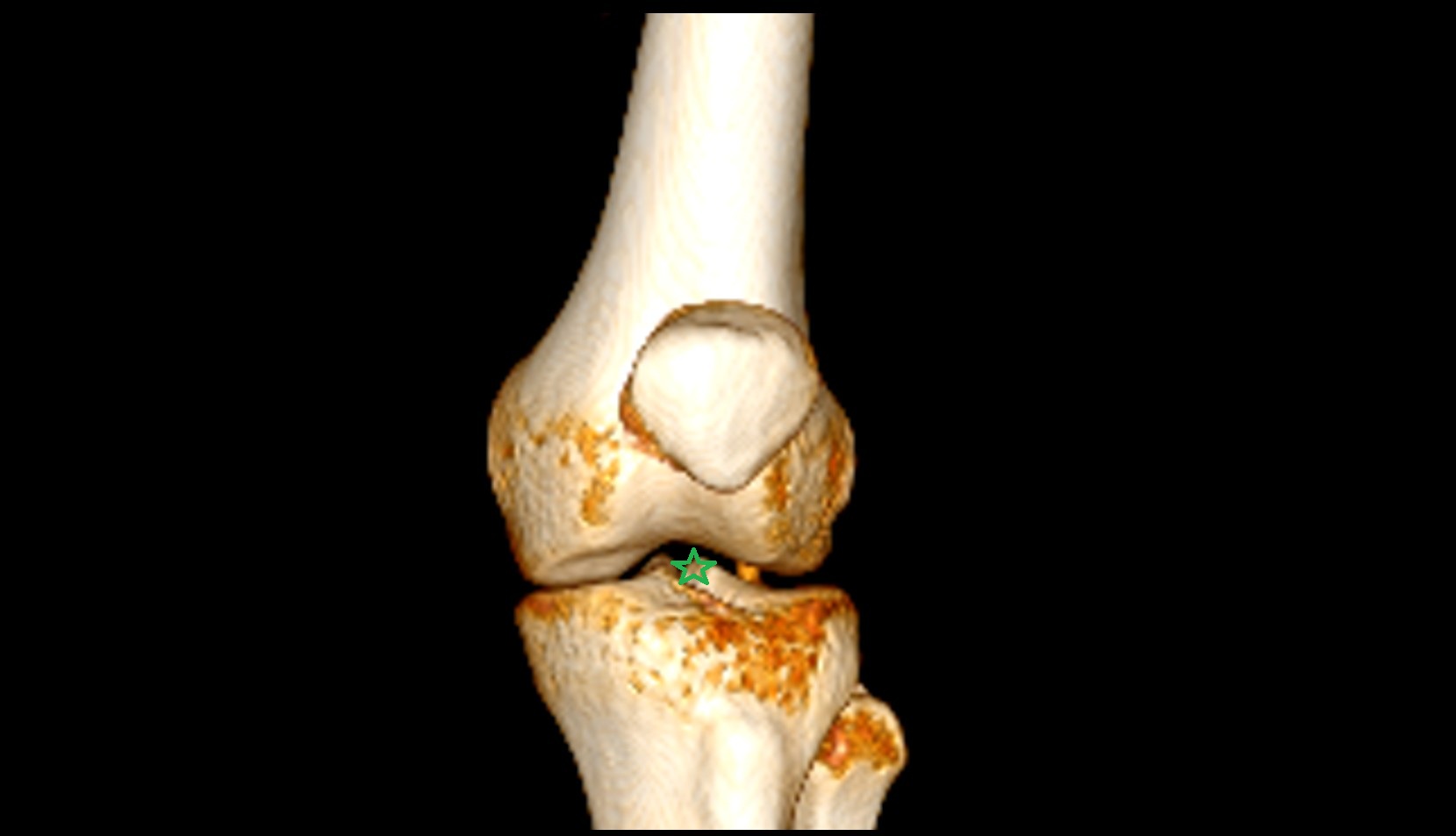 knee joint 3d