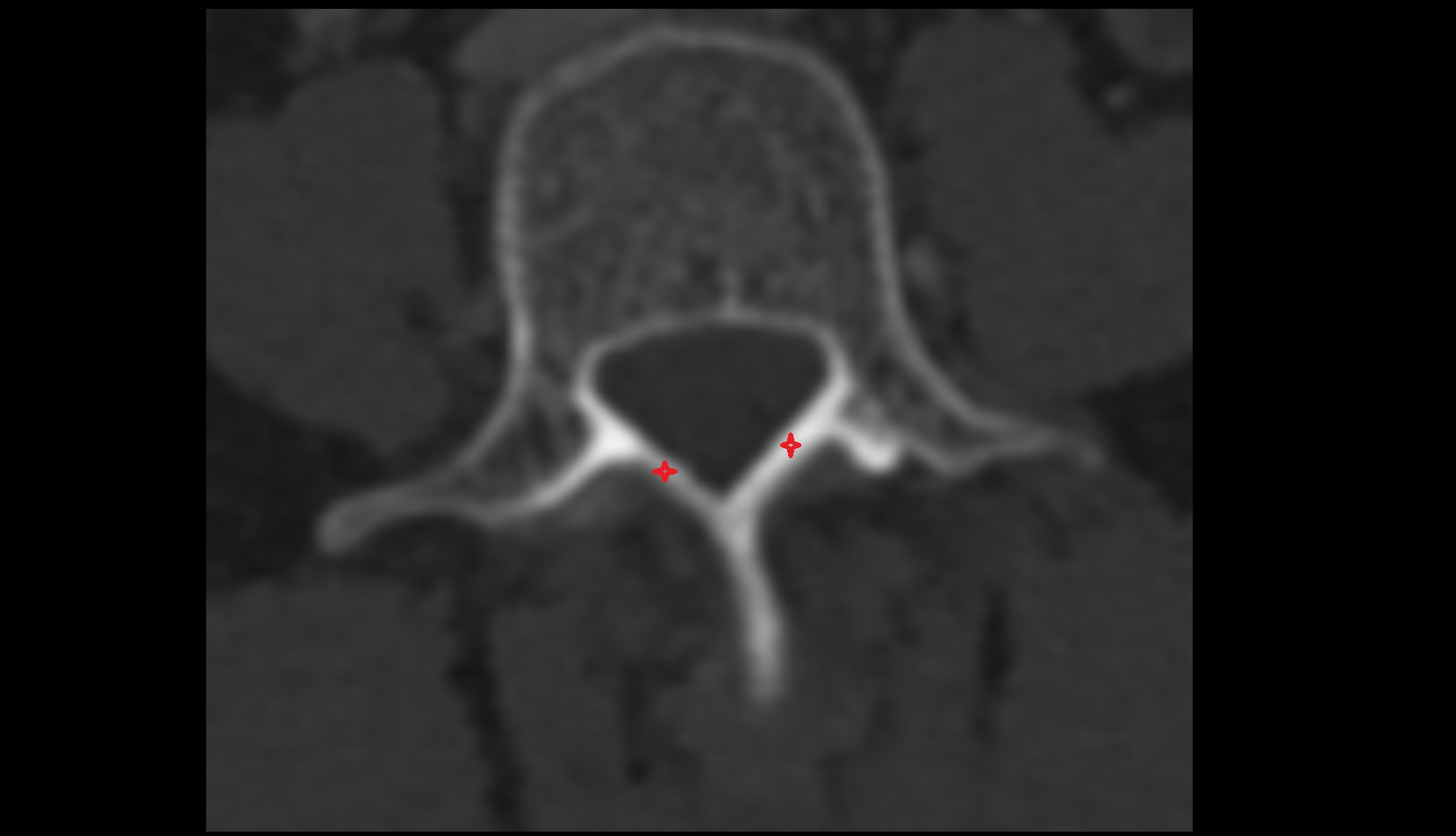 laminae of vertebrae ct axial image