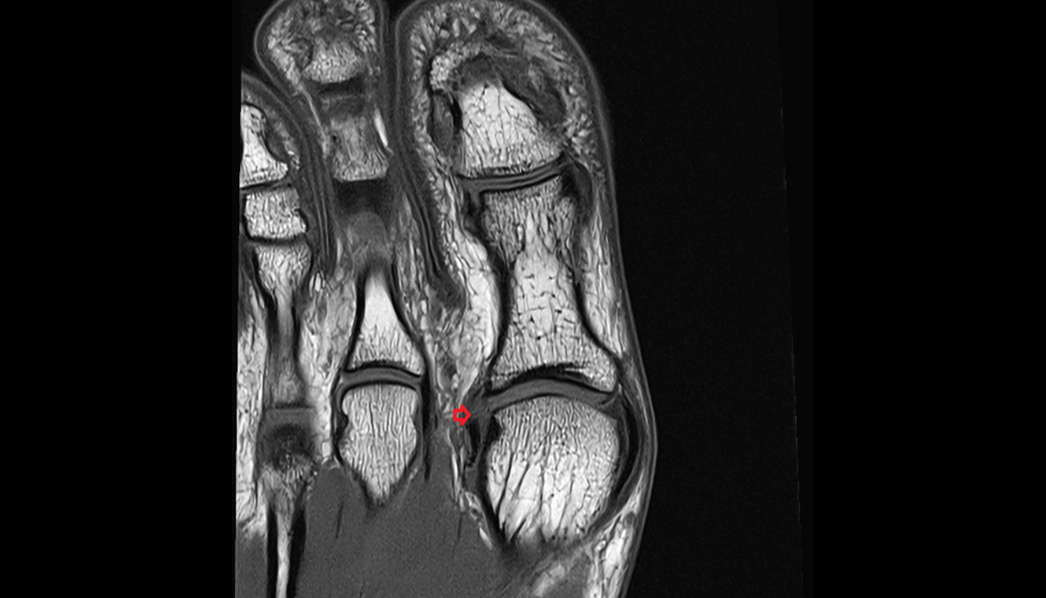 lateral collateral ligament of big toe (lateral metatarsophalangeal collateral ligament)  axial cross sectional anatomy 3T MRI AI enhanced radiology image-img-00000-00000_00001