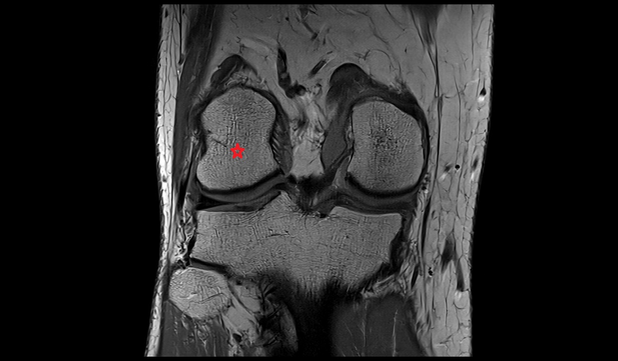 lateral condyle of the femur anatomy 3t mri image