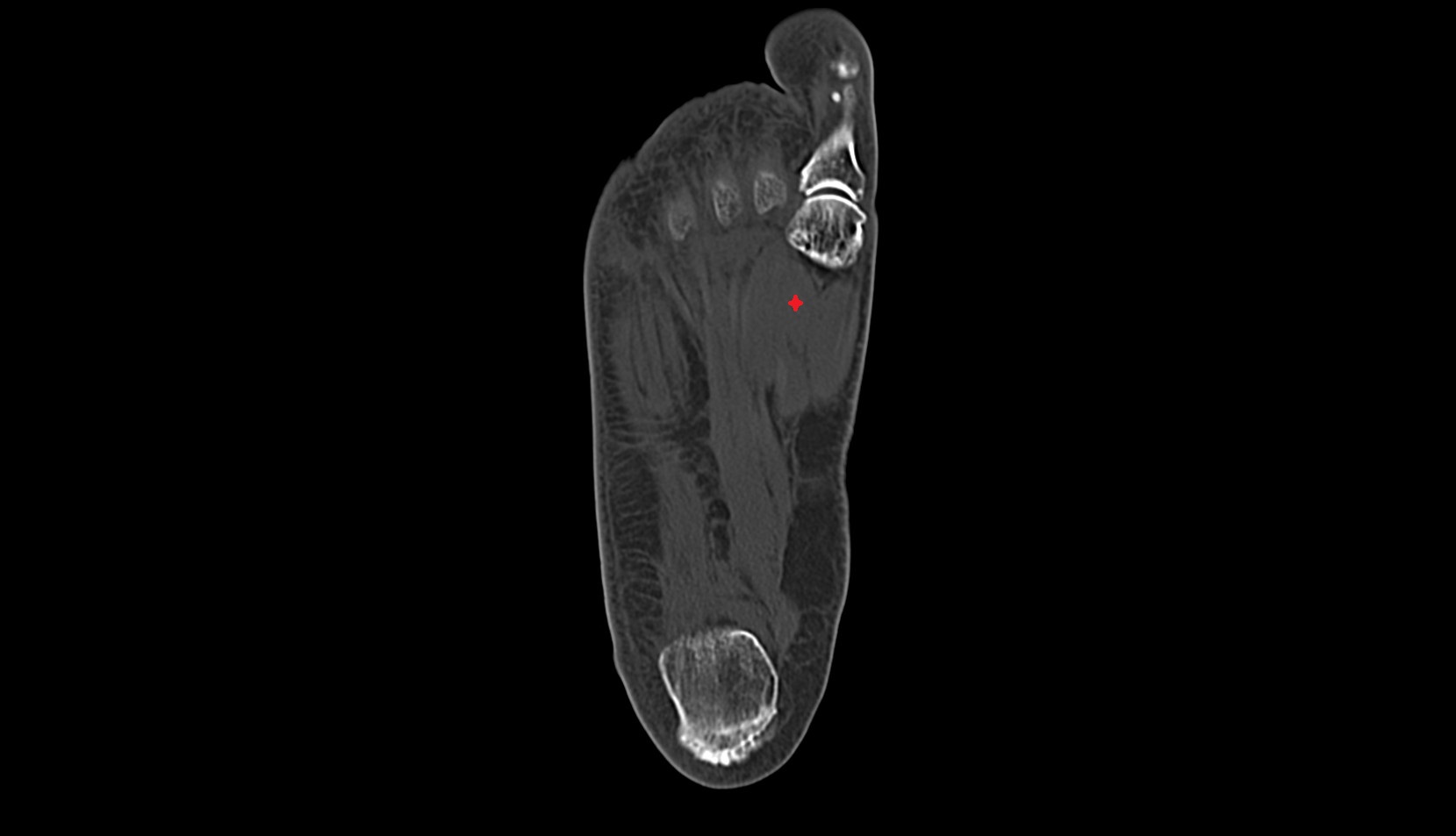 lateral head of flexor hallucis brevis muscle  ct axial anatomy