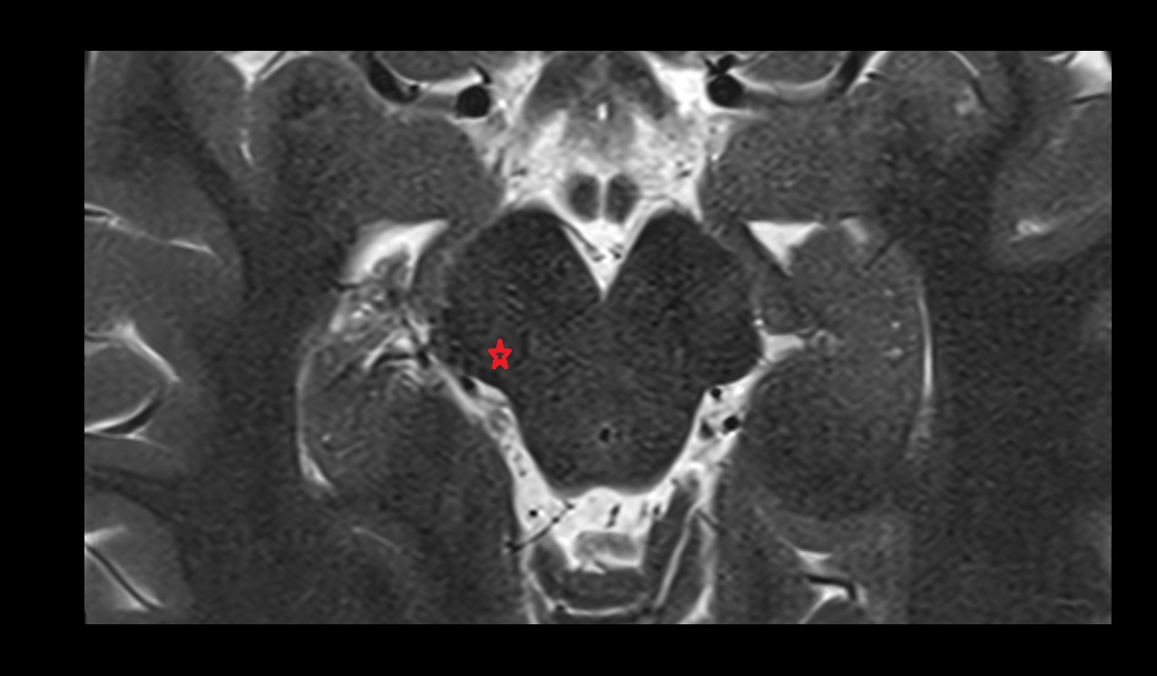 lateral longitudinal fasciculus mri 3t axial image