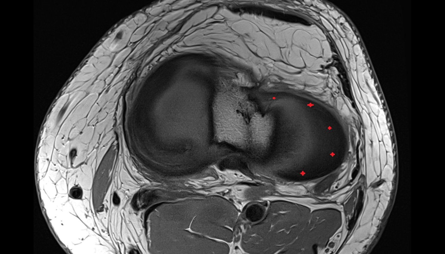 lateral meniscus axial cross sectional anatomy 3T MRI AI enhanced  radiology  anatomy image-img-00000-00000