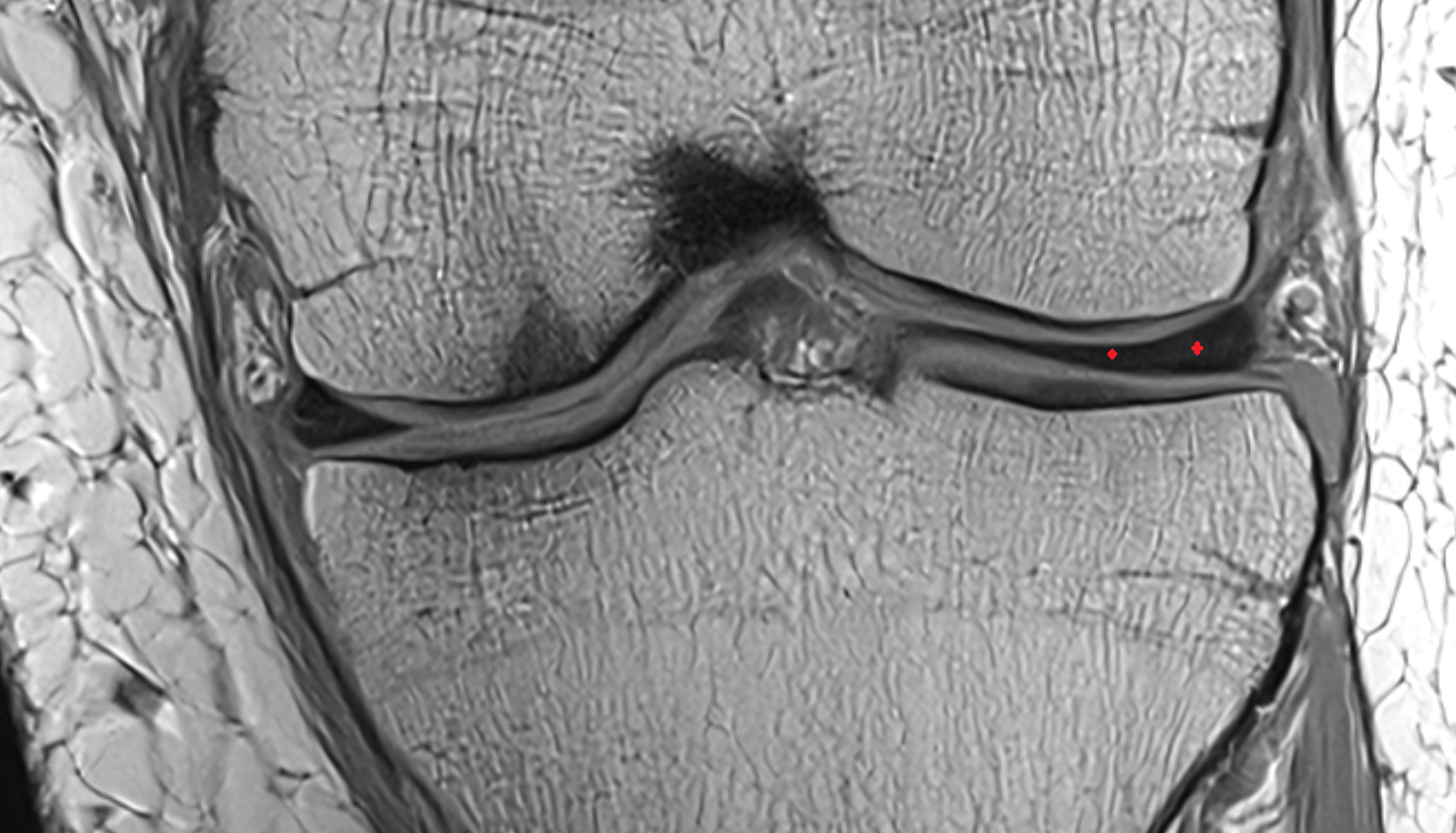 lateral meniscus  coronal cross sectional anatomy 3T MRI AI enhanced  radiology  anatomy image-img-00000-00000