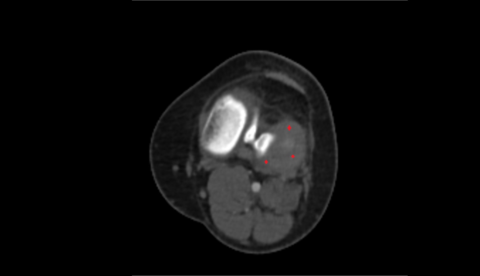 lateral meniscus ct axial image