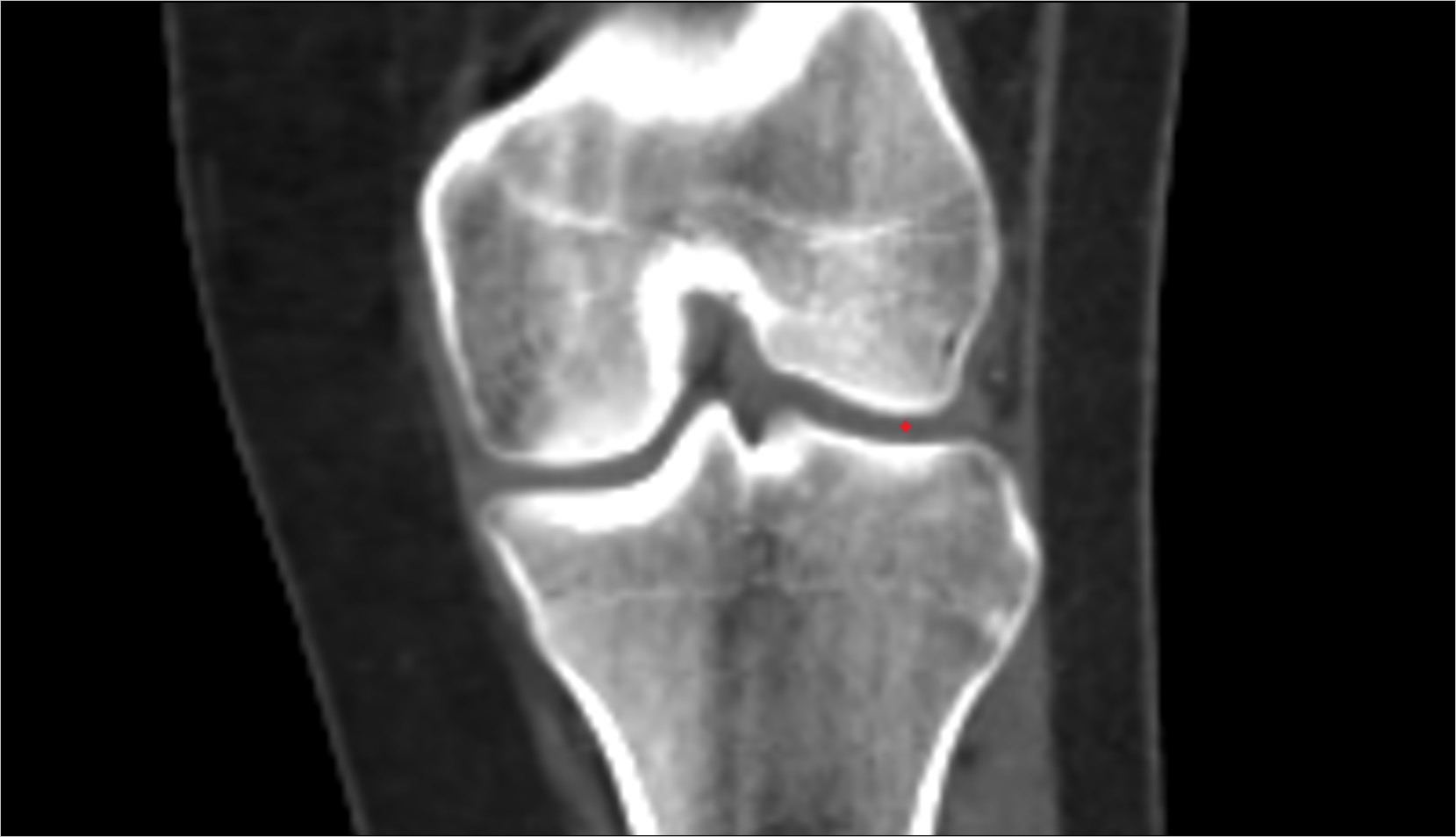 lateral meniscus ct coronal image