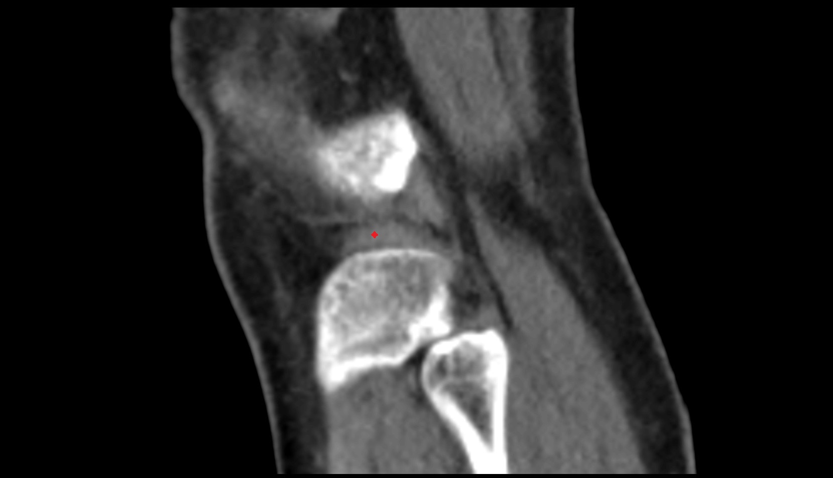 lateral meniscus ct sag image