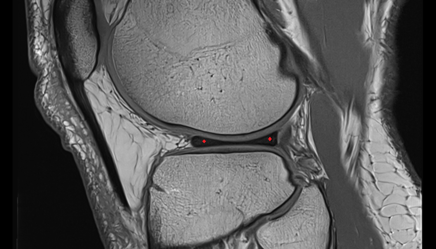 lateral meniscus  sagittal  cross sectional anatomy 3T MRI AI enhanced  radiology  anatomy image-img-00000-00000
