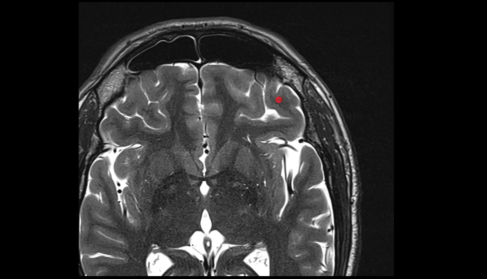 lateral orbital gyrus MRI 3T axial image