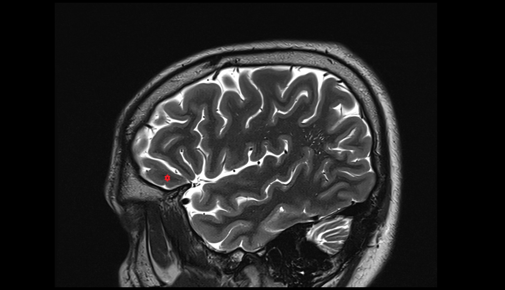 lateral orbital gyrus MRI 3T sagittal image