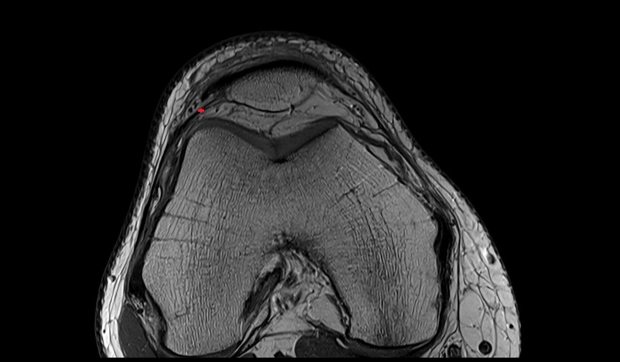 lateral patellar retinaculum anatomy image