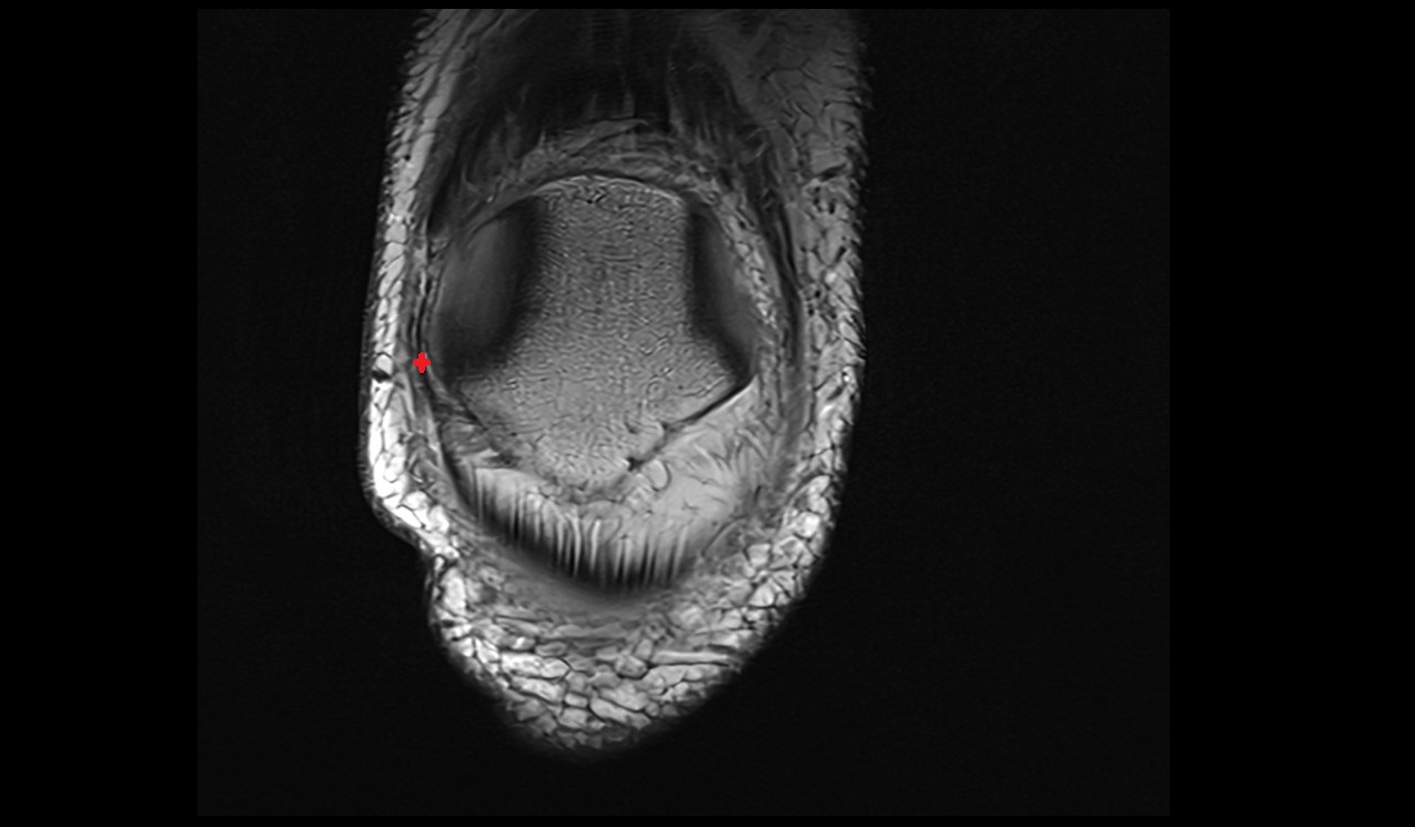 lateral patellar retinaculum anatomy image mri 3t