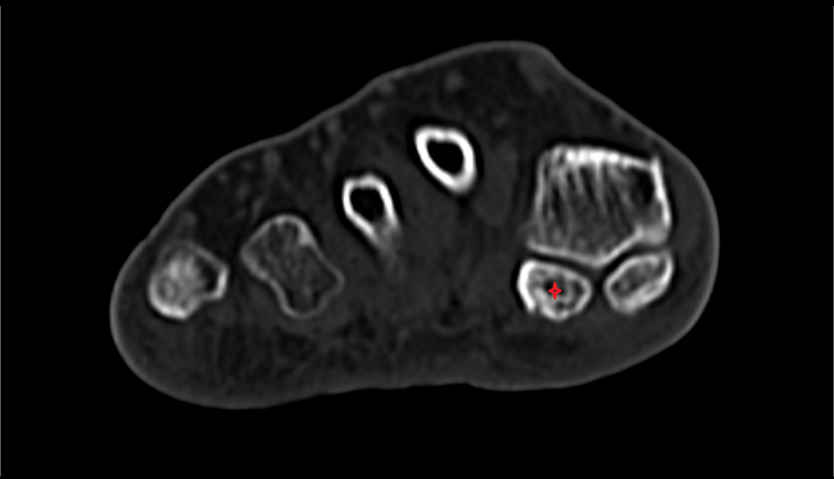 lateral sesamoid bone TOE CT AXIAL