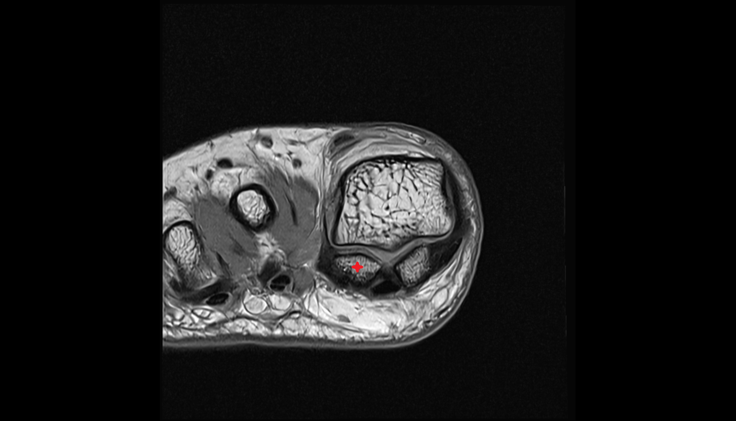 lateral sesamoid bone axial cross sectional anatomy 3T MRI AI enhanced radiology image-img-00000-00000