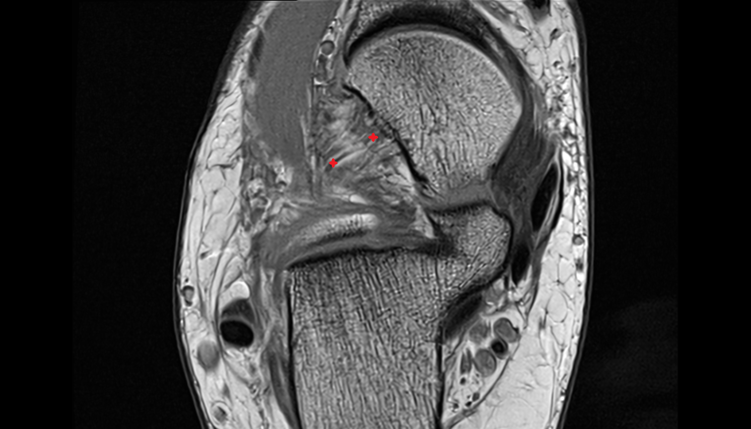 lateral talocalcaneal ligament  sag cross sectional anatomy 3T MRI AI enhanced radiology image-img-00000-00000